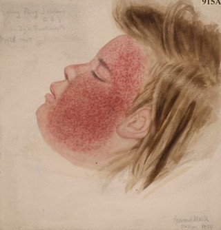 Diffuse erythematous eruption on the face after an injection of diphtheria antitoxin