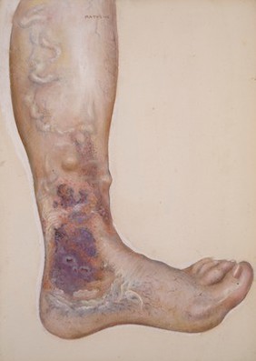 Subcutaneous bleeding as a result of severe varicose veins on the legs