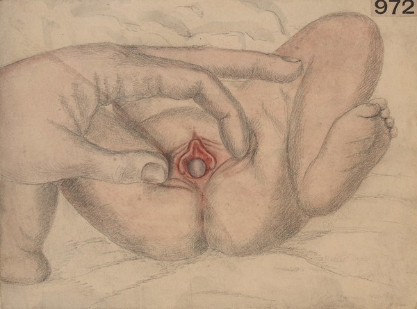 Fluctuating swelling at the vulva of an infant suffering from pyocolpos