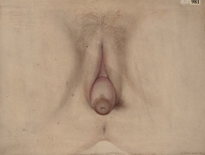 Hypertrophic elongation of the cervix uteri