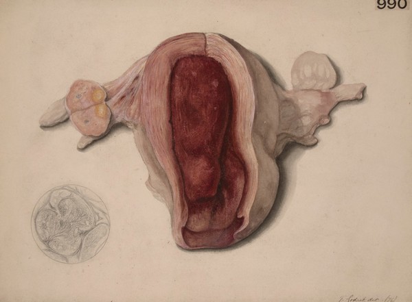 Uterus containing a fibrinous polypus