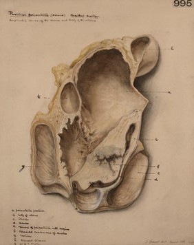 Sagittal section of the female genital organs from a case of retro-uterine perimetritis