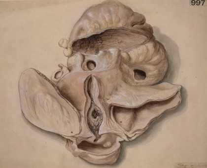 Bladder and uterus from a case of serous perimetritis