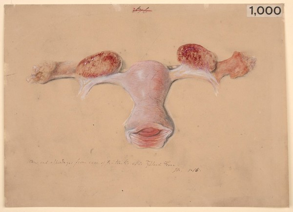 Uterus and appendages from a case of peritonitis after enteric fever
