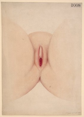 Prolapse of the vagina