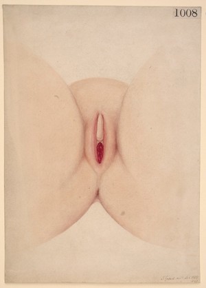 view Prolapse of the vagina