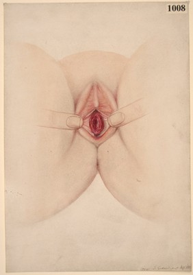 Prolapse of the vagina