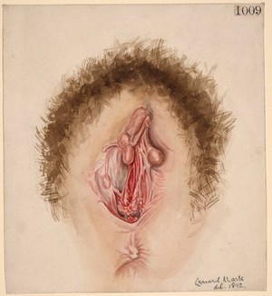 view Mucous membrane of the vagina showing scarring and puckering