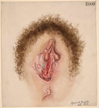 Mucous membrane of the vagina showing scarring and puckering