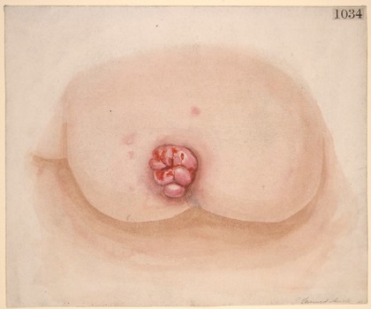 Epithelioma of the nipple