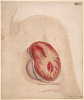 Scirrhous carcinoma of the breast