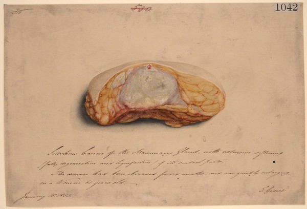 Scirrhous carcinoma of the mammary gland