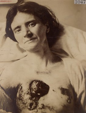 Patient who had a recurrent carcinoma of the right breast