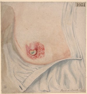 view Paget's disease of the nipple