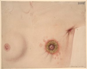view Eczema of the nipple associated with scirrhous of the breast
