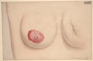 view Eczema of the nipple