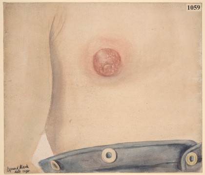 Inflammation of the male breast