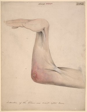 view Contraction of the elbow and wrist after a burn