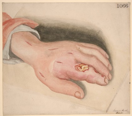 Hand with suppurating poisoned wound