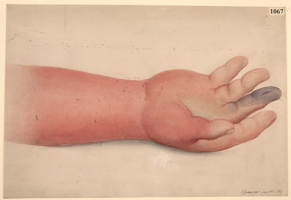 Hand with cellulitis following upon a poisoned wound