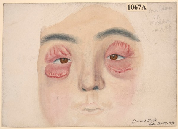 Erysipelas of the eyelids