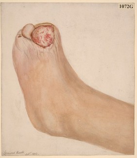 Long standing perforating ulcer of the foot