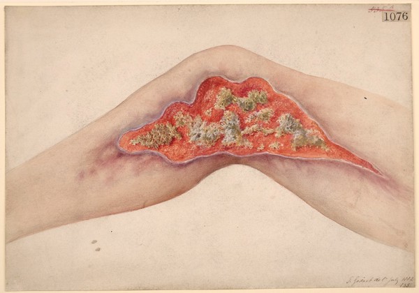 Ulcer after treatment by sponge grafting