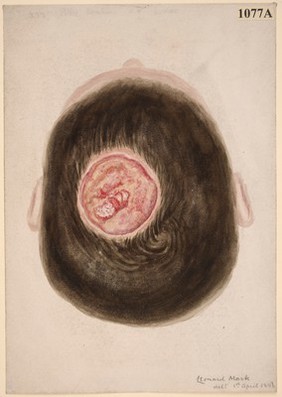 Curious ulcer on the scalp of an infant