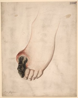 view Dry gangrene of the great toe of the foot