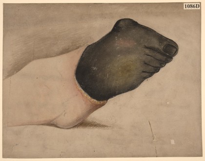 Dry gangrene of the foot