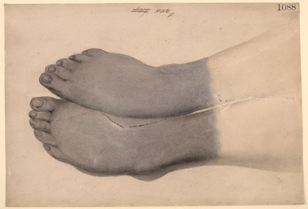 Dry gangrene of both feet from frostbite