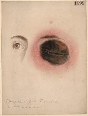 view Gangrene of both eyelids on the left side