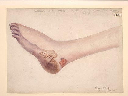 Gangrene of the foot and leg