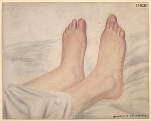 view Feet of a woman with Raynaud's disease