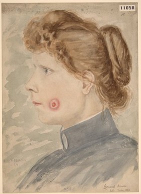 Tubercular ulcer on the left cheek of a woman