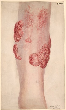 Leg of a woman with a tubercular fungating ulcer