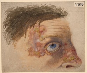 view Detail of the face of a woman affected with tubercular lupus