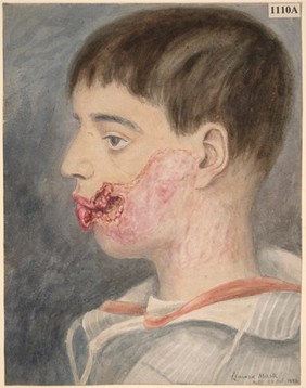 Chronic tubercular ulceration around the mouth of a boy