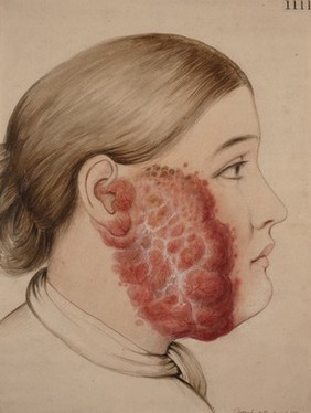 Lupus vulgaris sive hypertrophicus affecting the cheek