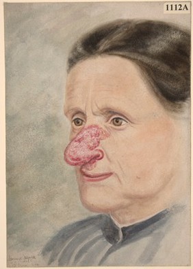 Lupus-like eruption on the nose of a woman