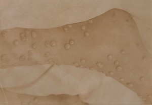 view Foot of a child with smallpox and early scarlet fever, 11th day of eruption