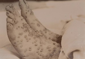 view Feet of a vaccinated patient, 12th day of eruption