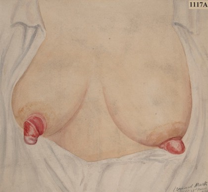 Primary syphilitic sores on the nipples of a woman