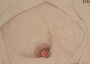 view Primary syphilitic sore on the nipple