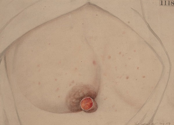 Primary syphilitic sore on the nipple