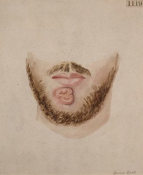 Primary syphilitic sore on the chin of a man