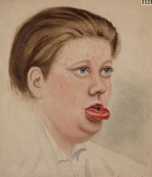 view Face of a girl with a primary syphilitic sore on the lower lip