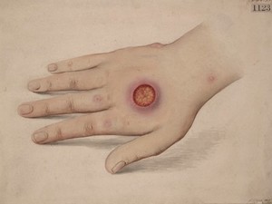 view Primary syphilitic sore on the back of the hand