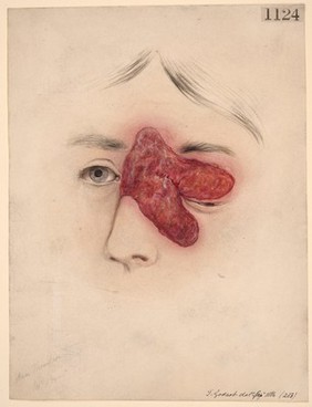 Face of patient with large, primary syphilitic ulcer