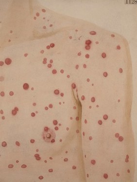 Chest, shoulder and arm of a man with a secondary syphilitic rash